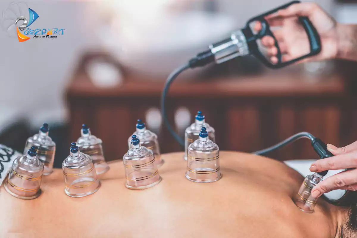cupping therapy